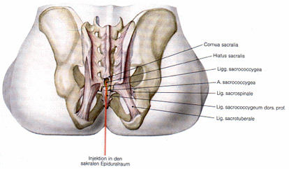 Illustratio Caudal epidural injection