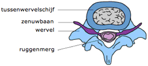 Tussenwervelschijf