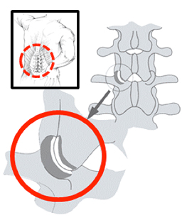 Illustration Denervation