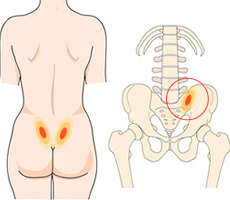 SI Joints injection