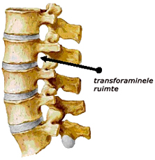 Transforaminal epidural injections space